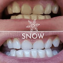 Load image into Gallery viewer, Snow® At-Home Teeth Whitening Kit - 50% Off