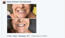 Load image into Gallery viewer, Special Offer - SNOW Teeth Whitening™ System