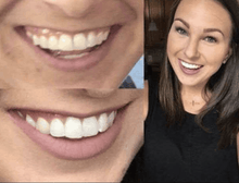 Load image into Gallery viewer, SNOW TEETH WHITENING™ ZAHNWEISS-SYSTEM FÜR ZUHAUSE [ALL-IN-ONE KIT]
