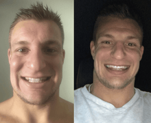 Load image into Gallery viewer, SISTEMA DE CLAREAMENTO DENTAL CASEIRO SNOW™ [KIT TUDO-EM-UM]
